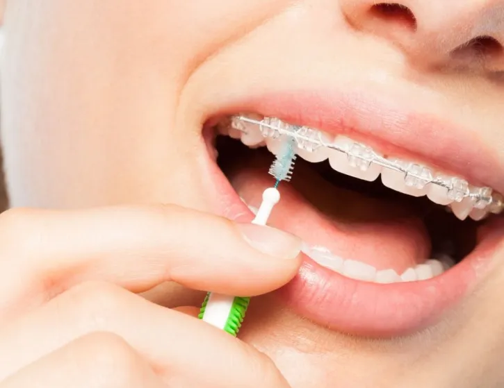 Czy irygator to must-have przy leczeniu ortodontycznym?